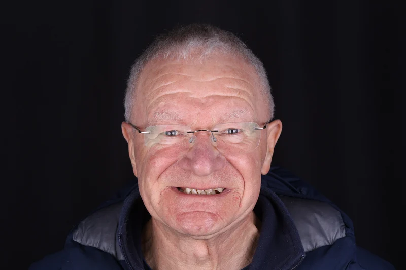 David before dental implant treatment