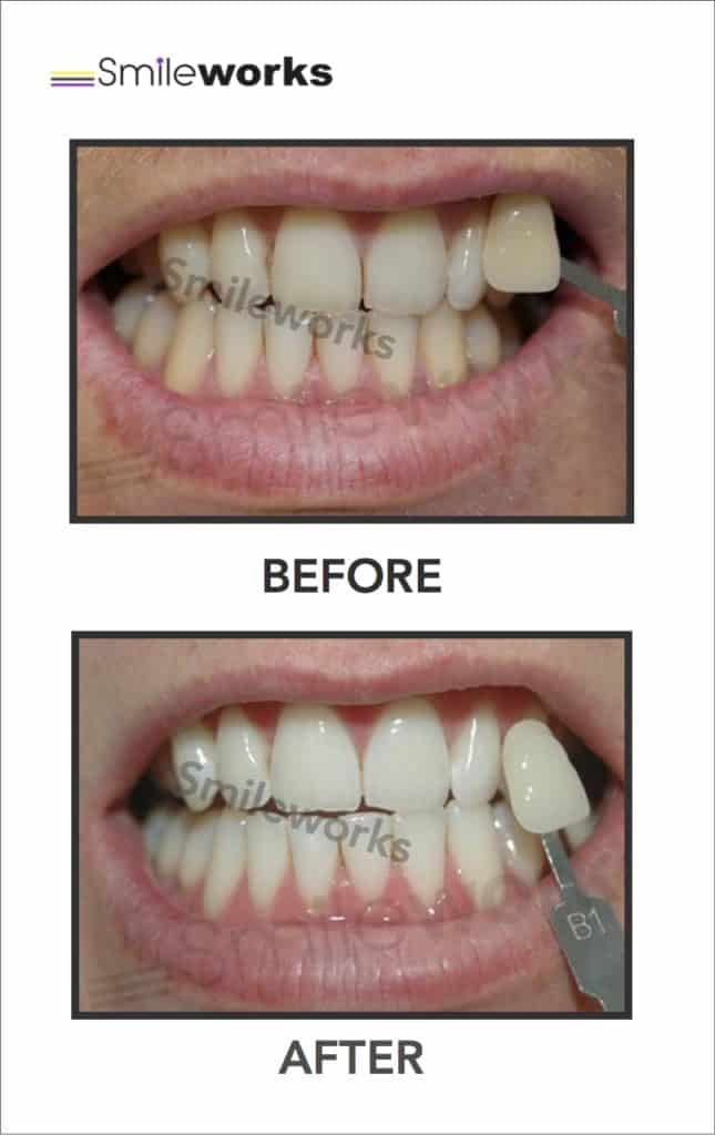 Enlighten teeth whitening process