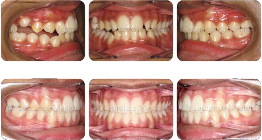 Remarkable Braces Liverpool | £48.56p/m *Free Whitening*