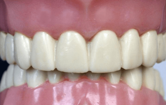 Can Overbites & TMJ Headaches Be Corrected with Crowns or Veneers?
