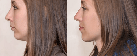 What is an Overbite?  Deep Overbite Treatment for Adults
