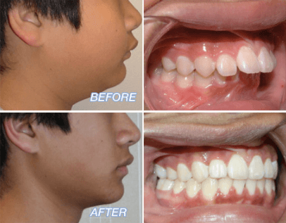 overjet teeth overbite adult normal orthodontic causes anterior overlap problems 8mm dentist treatments 4mm