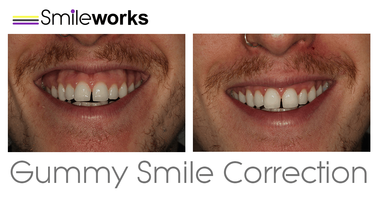 Gummy Smile Treatment  Toxins, contouring & crown lengthening