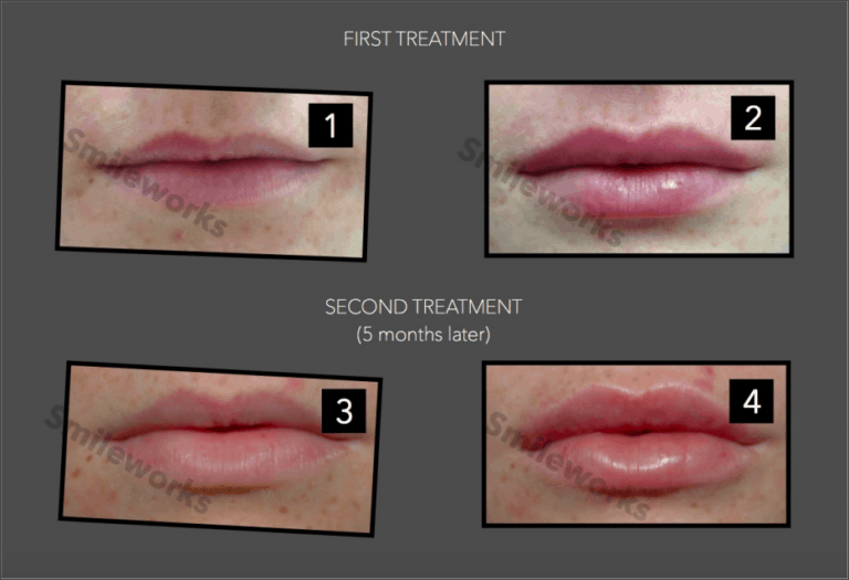 Lip Fillers Gone Wrong Dissolve Filler With Hyalase Advice Cost