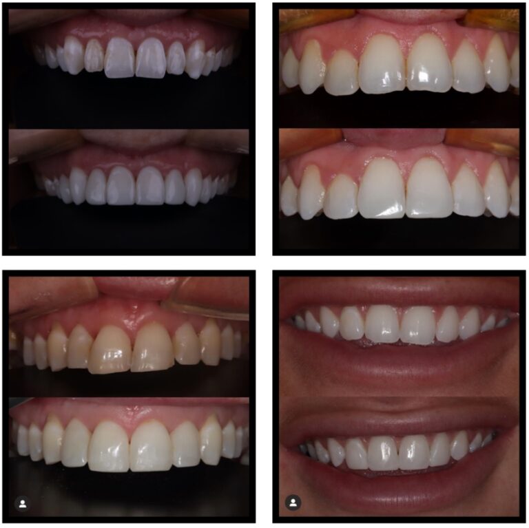 Composite bonding Liverpool | “life changing” fix for uneven smiles