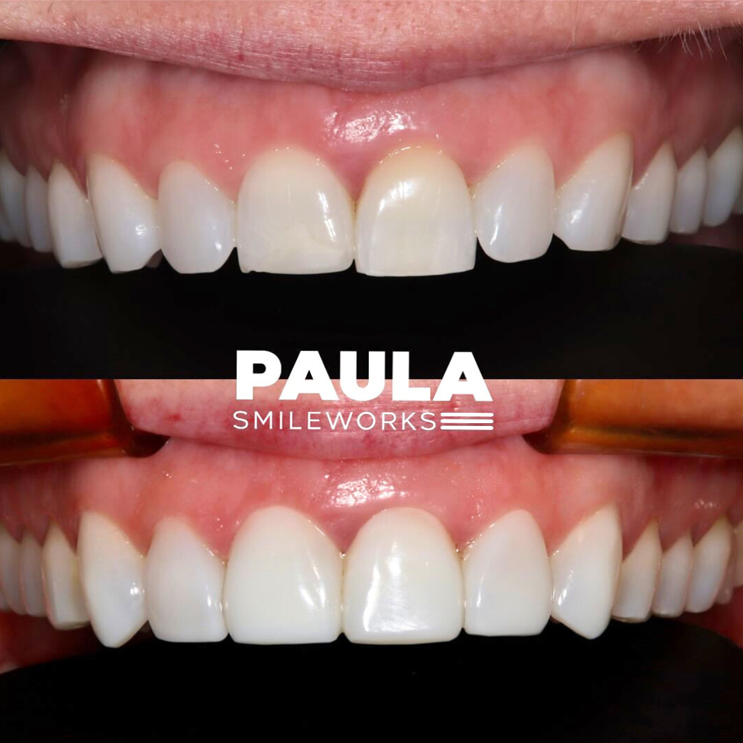 paula composite bonding