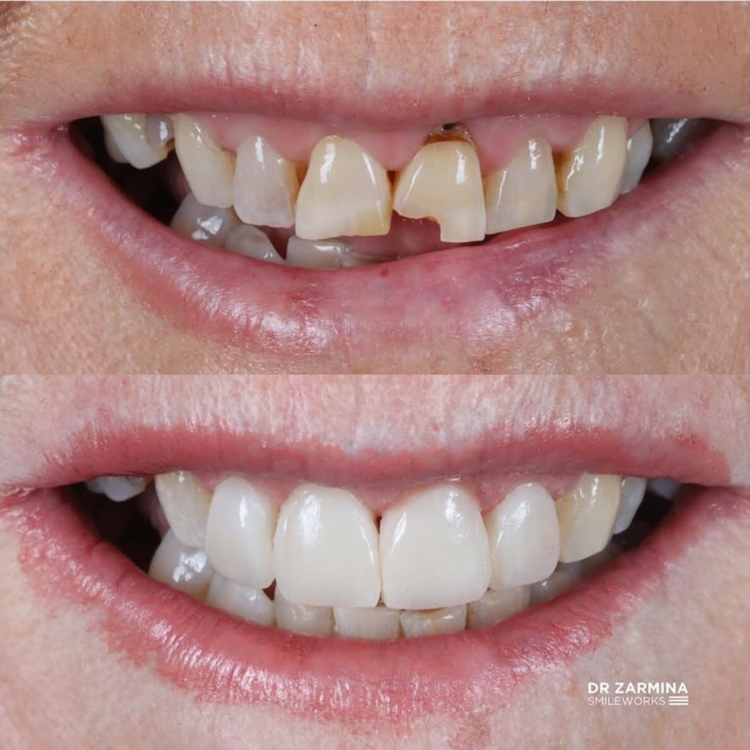 zarmina composite veneers